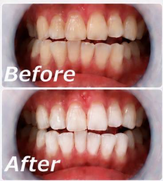 セルフホワイトニング Before After